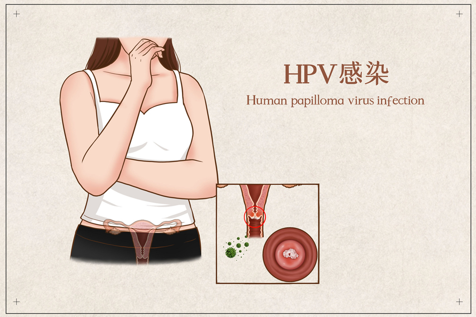 HPV陽性可以買保險(xiǎn)